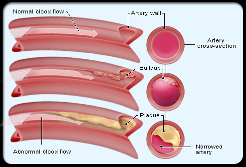 Cholesterol Diet Exercise