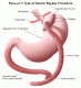 How Does Gastric Bypass Work
