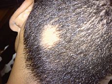 Herbal Remedies For Alopecia Areata