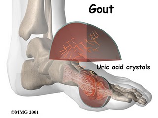 Can Beans Affect Gout? – The ‘gout-ed’ Not Full Of The Beans