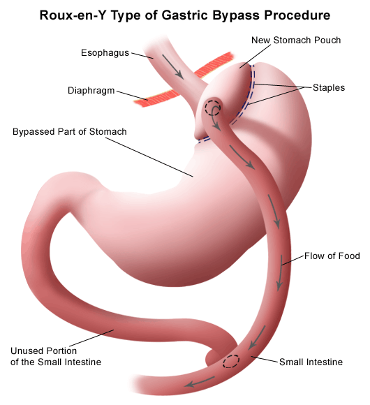 How Does Gastric Bypass Work