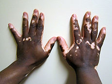 Herbal Remedies For Vitiligo