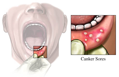 Home Remedies For Canker Sore