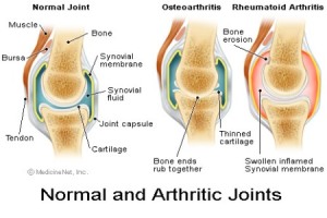 Arthritis Diet Exercise