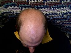 Herbal Remedies For Baldness