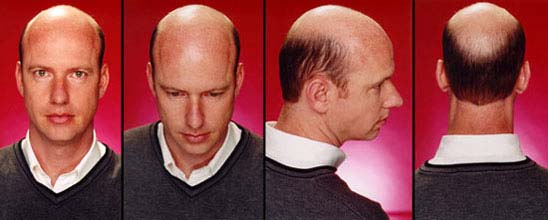 Home Remedies For Baldness