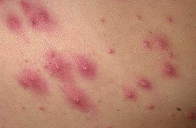 Home Remedies for Boils