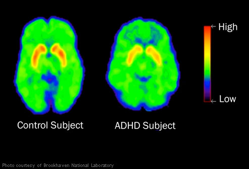 Natural Remedies For ADHD In Children
