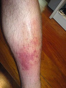 Herbal Remedies For Cellulitis