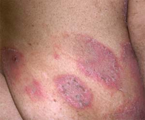 Home Remedies for Eczema