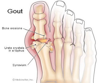 Best Foods To Control Gout