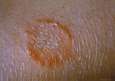 Home remedies for ringworm